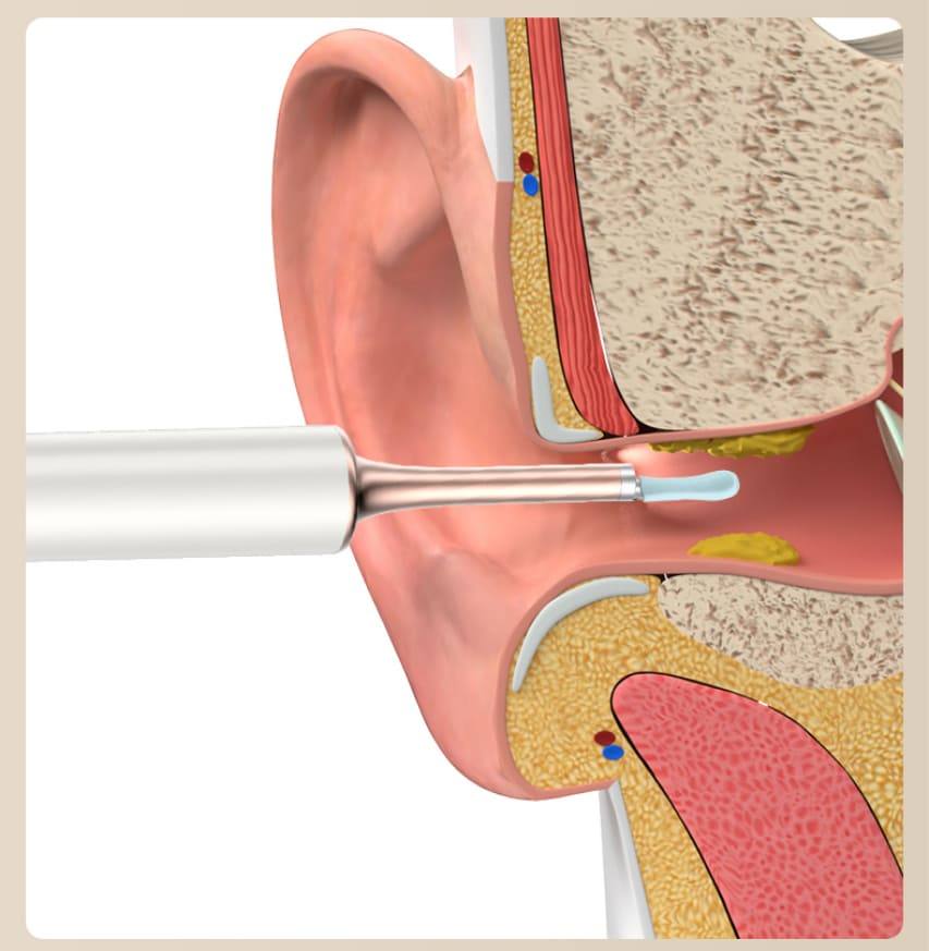 מסיר שעוות אוזניים מנקה את האוזן